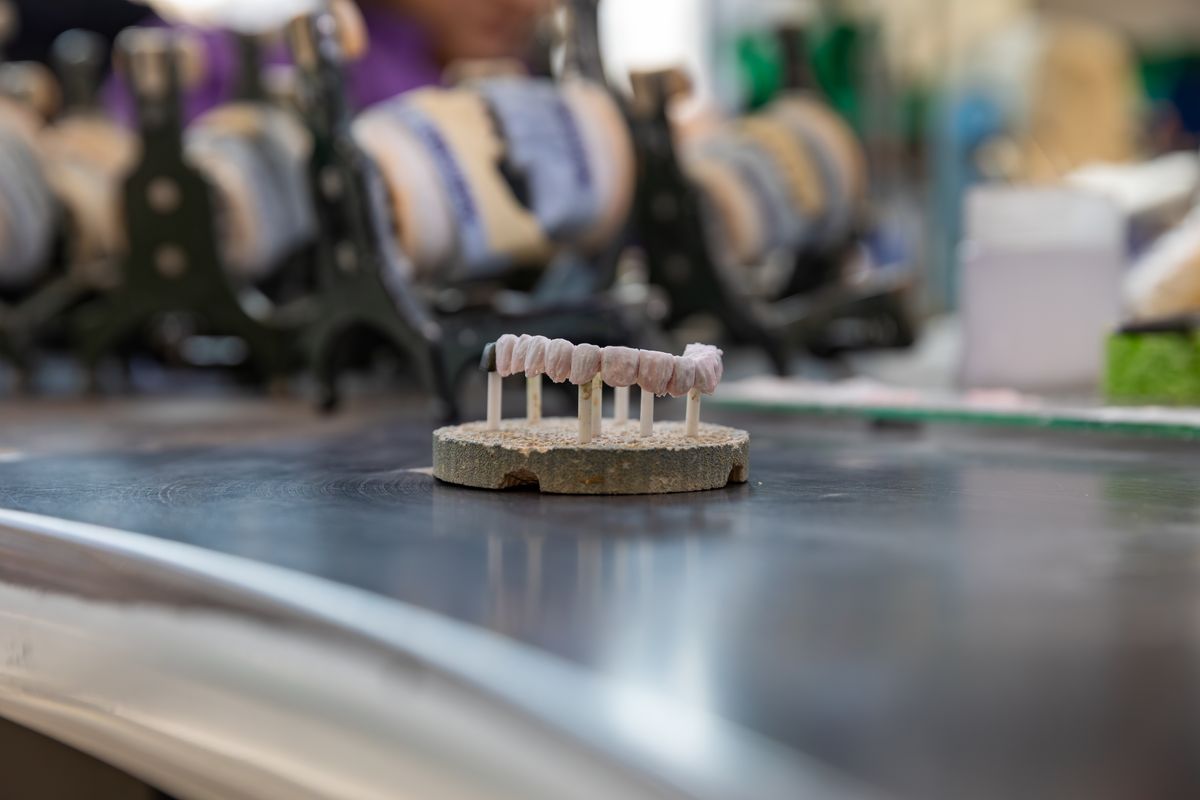 Zirconiu stratificat pe implant — Pavăl Dent
