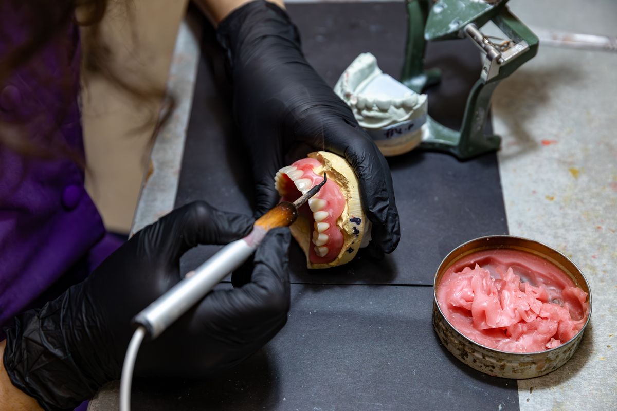 Proteză pe implant (overdenture) — Pavăl Dent