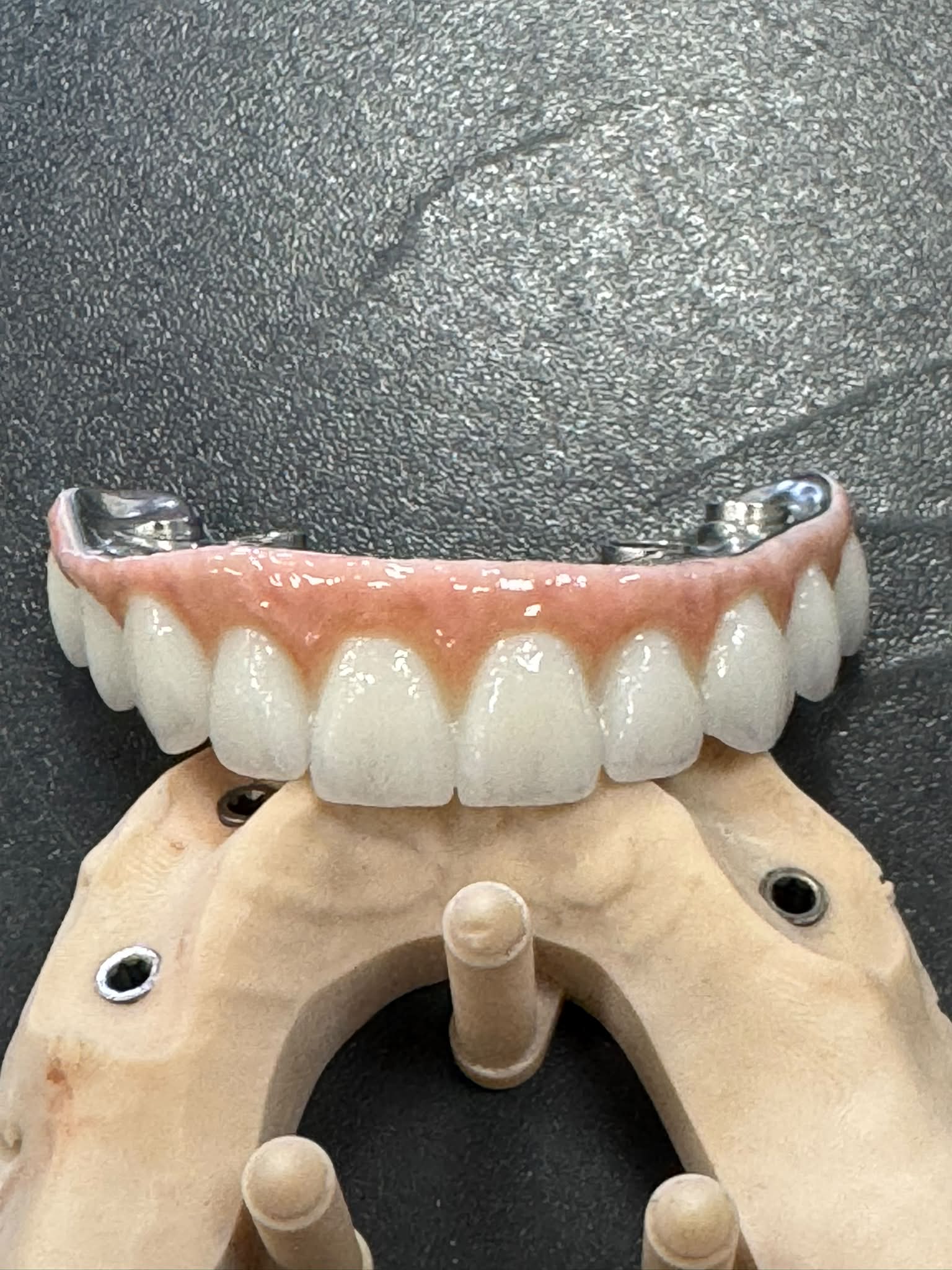 Suprastructură All-on zirconiu — vedere frontală pe model