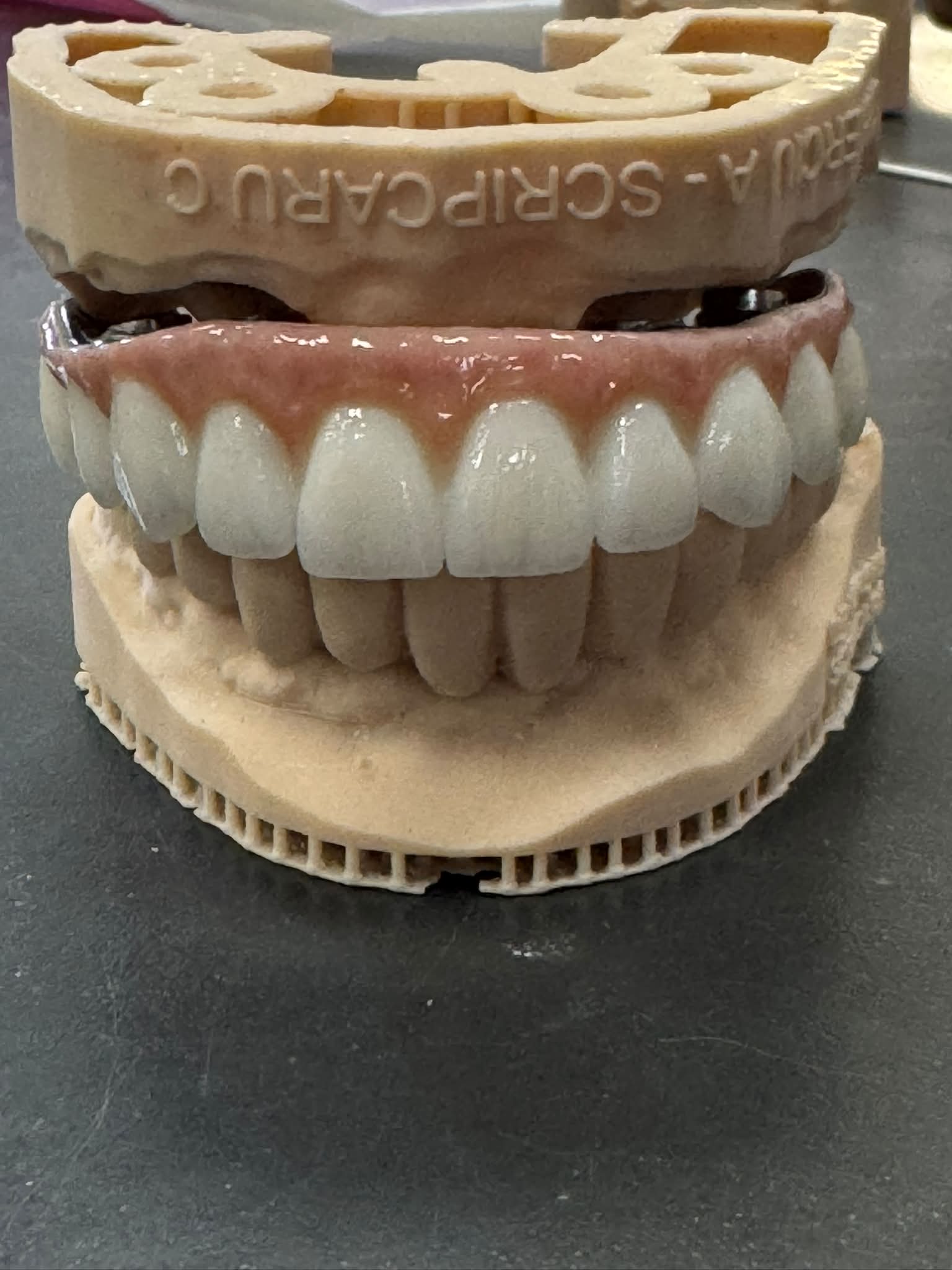 Suprastructură zirconiu pe analogi de implant
