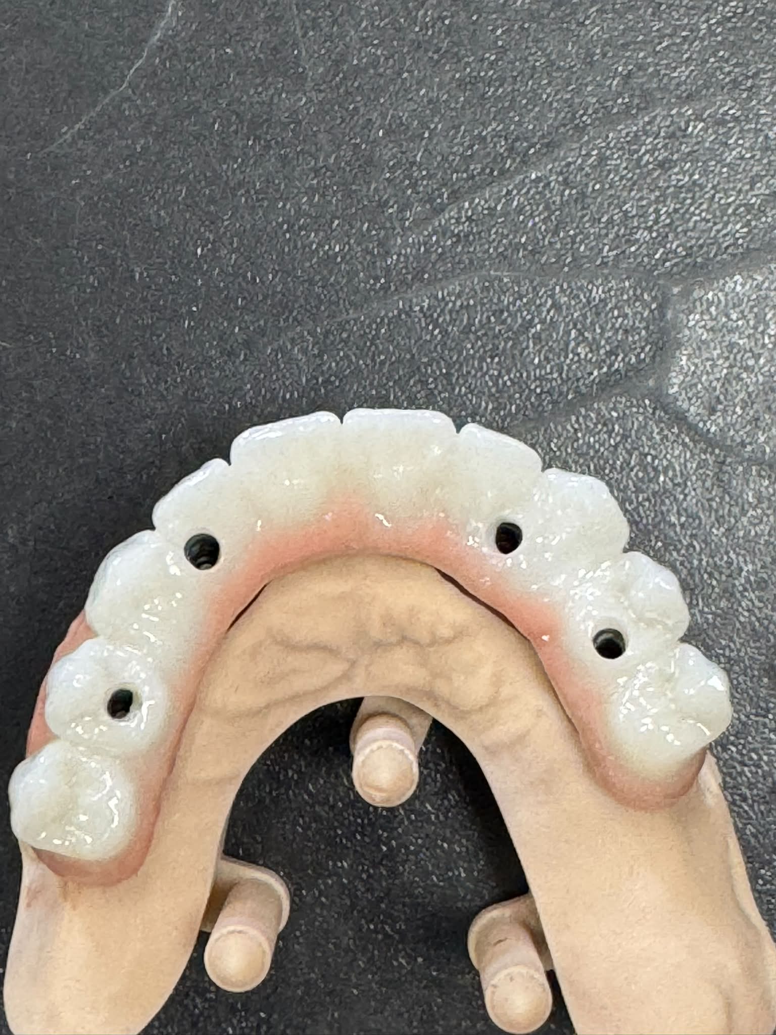 All-on zirconiu — vedere ocluzală cu canale de înșurubare