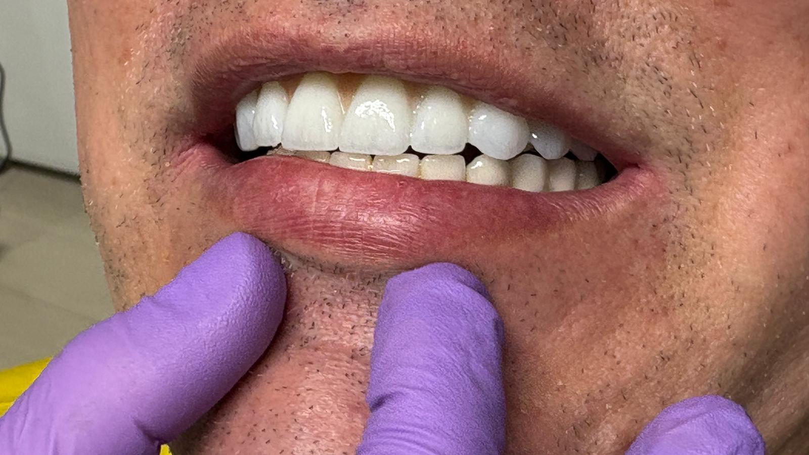 All-on zirconiu — finisare și caracterizare ceramică