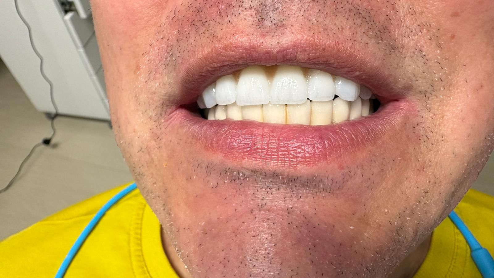 Rezultat intraoral All-on-X — zâmbet pacient